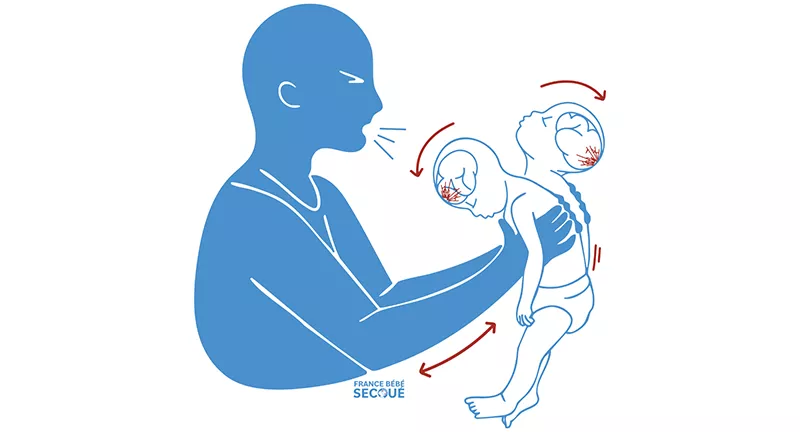 Syndrome du bébé secoué : prévention et formation